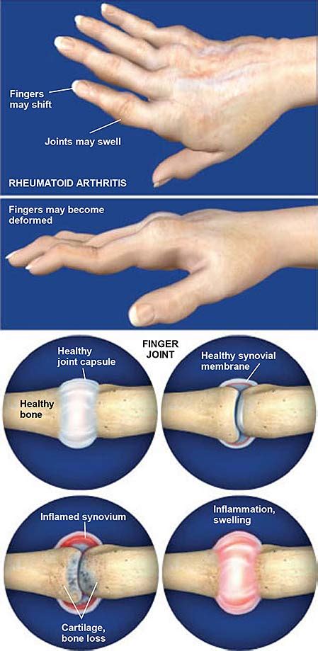 Rheumatoid Arthritis Treatment Natural