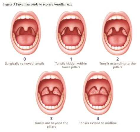 Tonsillitis Grading Scale