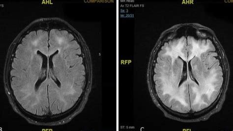 Doctors release scans of brain showing effects of cocaine use | Photo