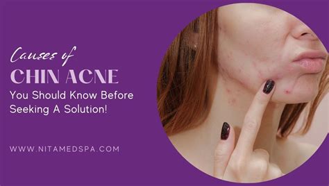 Causes Of Chin Acne You Should Know Before Seeking A Solution!