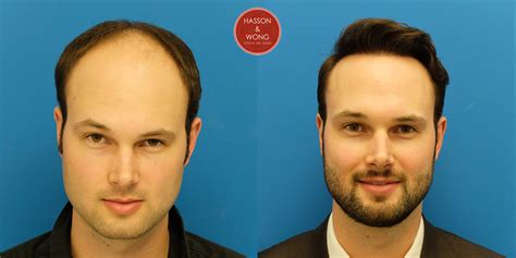 Hair Transplant Photo 5266 Grafts - Hasson & Wong