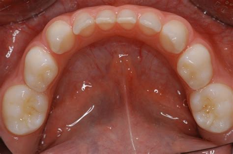 Mandibular deciduous teeth without caries (general view) - DocCheck