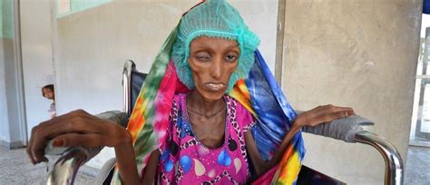 This picture of a starving girl shocked the world. But it’s just another tragedy in Yemen’s ...