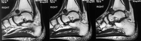 PVNS of the Ankle | Sudden Acute Ankle Pain | Dr HC Chang