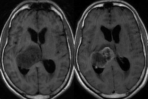 Glioma: Glioma Mri