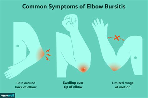 Elbow (Olecranon) Bursitis: Signs and Treatments