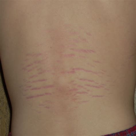 Bartonella Rash vs Stretch Marks