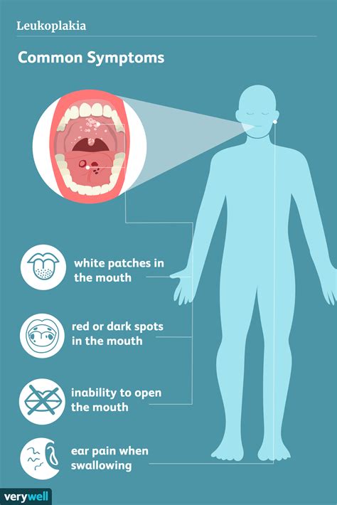 Leukoplakia: Symptoms, Causes, Diagnosis, and Treatment