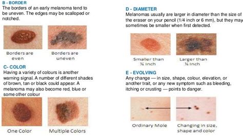 Melanoma On Scalp Stages