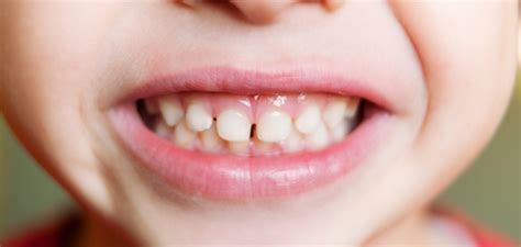 Why Do Kids Wear Silver Teeth? Understand Its Advantages