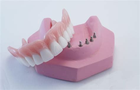 How to Care For Your Snap On Denture - Top Rated Cosmetic & General Dentist in Mesa AZ 85203 ...