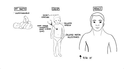 Noonan Syndrome a genetic condition - YouTube