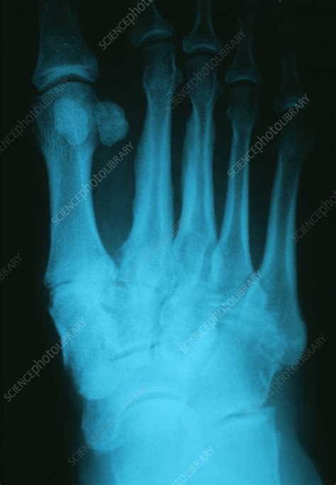 Osteoarthritis of foot, X-ray - Stock Image - M110/0464 - Science Photo ...