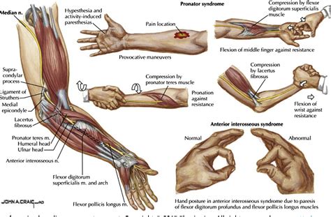 Figure 1 from Diagnosis and Treatment of Work-Related Proximal Median and Radial Nerve ...