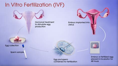 In-Vitro Fertilization (IVF)