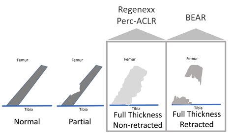 The BEAR Implant for ACL Tears - Regenexx