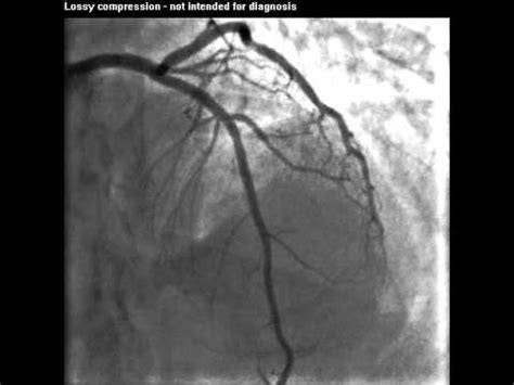 Coronary Angiogram - LAD - YouTube