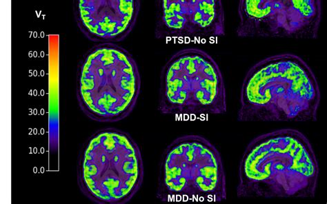 Depression Brain Scan