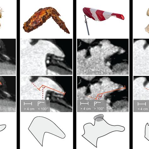 (PDF) Left Atrial Appendage Morphology in Patients with Suspected ...