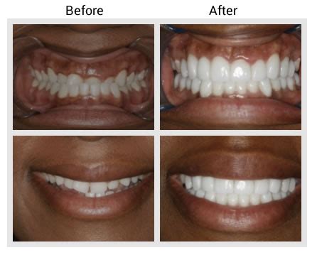 Teeth Veneers Before And After