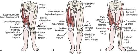 Genu valgum vs genu varus effect on patella - increased valgum actually causes lateral tracking ...