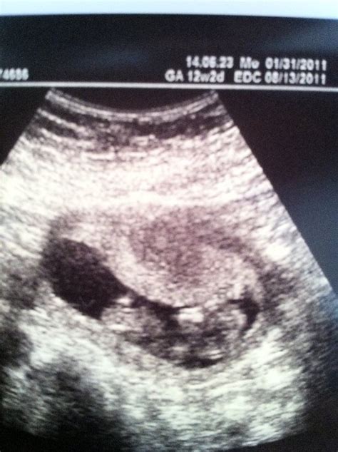 TheWheelerBunch: First Trimester 12 Week Ultrasound Nuchal translucency ...