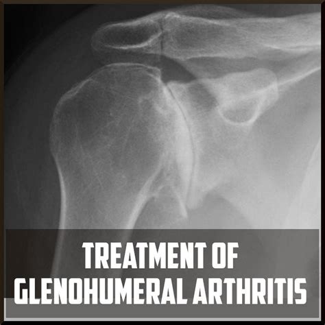 Treatment of Glenohumeral Osteoarthritis - Sports Medicine Review : r/sportsmedicine