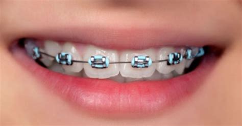 6 preguntas sobre los “brackets” | Ortodoncia | Pinterest | Babies, Braces and Baby blue