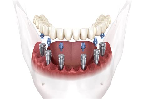 Full Mouth Dental Implants San Francisco | Replacing Full Set of Teeth