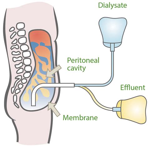 Types of Body Access for Dialysis | ORN