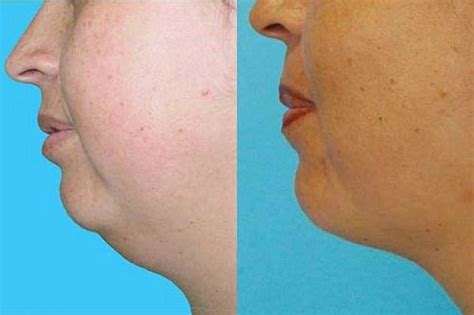 Eliminate Your Double Chin without Surgery! - Step To Health