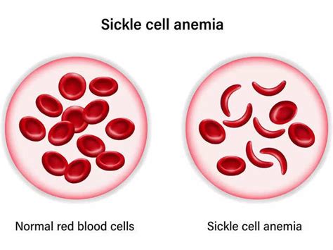 What Is Sickle Cell Disease? - Sickle Cell Disease, Which Affects 20 Mn ...