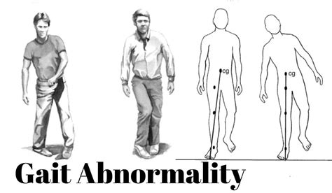 Types Of Gait Patterns