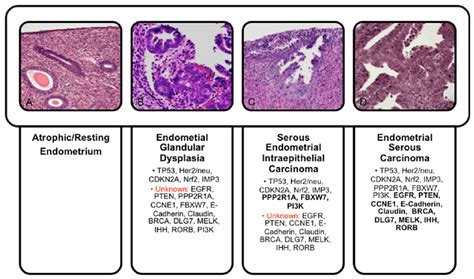 Endometrial Serous Carcinoma Model of Carcinogenesis. Endometrial ...