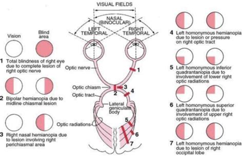 Case 1: Compressive lesions of the optic tract Flashcards | Quizlet