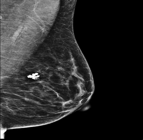 A mammogram of the left breast showed a left breast lesion with... | Download Scientific Diagram