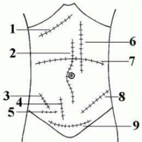 1- Kocher incision 2- Midline incision 3- McBurney incision 4- Battle ...