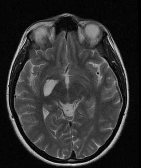 Choroidal fissure cyst - wikidoc