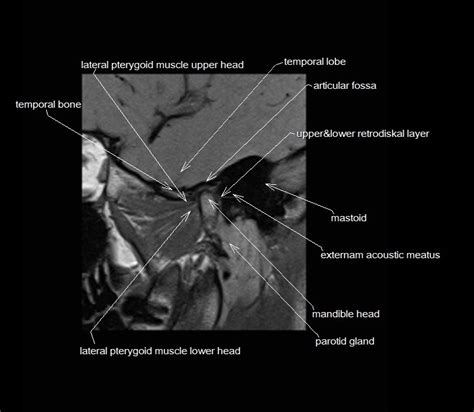 Temporomandibular Joint Anatomy | MRI TMJs Anatomy | Free Sagittal ...