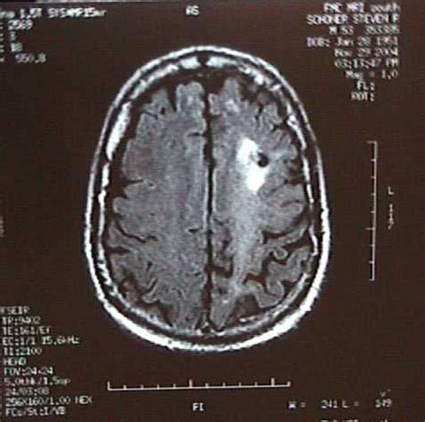 Brain Jack Image: Brain Biopsy