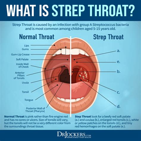 Strep Throat: Symptoms and 15 Natural Support Strategies