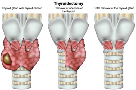 The 3 Best Thyroid Operations For Thyroid Cancer