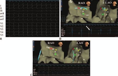 (A) Surface electrocardiograms show an evident delta wave due to an... | Download Scientific Diagram