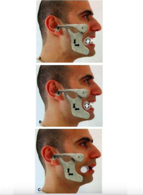 emDOCs.net – Emergency Medicine EducationCORE EM: Temporomandibular Joint (TMJ) Dislocation ...