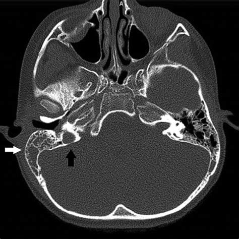 Computed tomography (CT) scan reveals opacification of the right... | Download Scientific Diagram