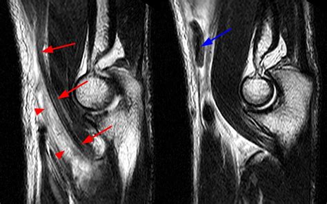 Distal Biceps Tendon Rupture Elbow - Radsource