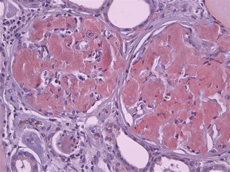 amyloidosis kidney histology