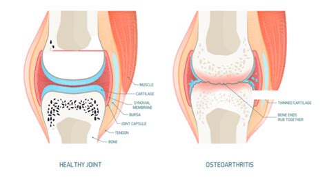 Osteoarthritis of the wrist (radio-carpal joint synovitis) - Ultrasound Guided Injections