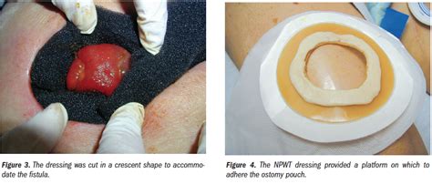 Colocutaneous Fistula Management in a Dehisced Wound: A Case Study