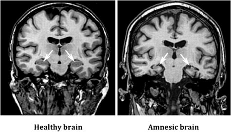 Amnesia : Causes, Symptoms, Diagnosis, Treatment, and Prevention